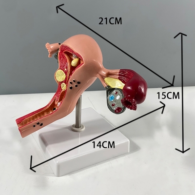 Анатомическая модель матки с патологиями Corpo ventre-4